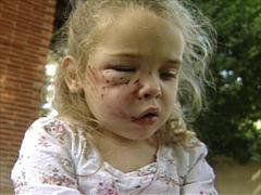 dog bite